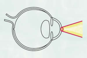 Knelpunteninventarisatie richtlijn Refractiechirurgie